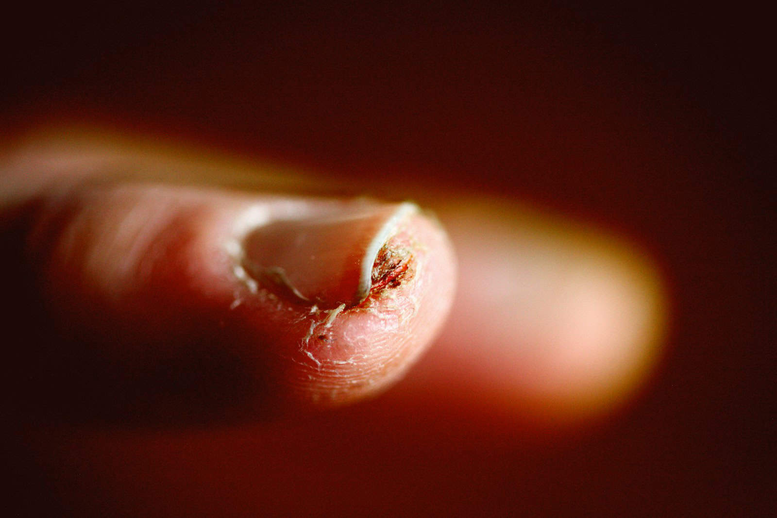Broken Fingernail